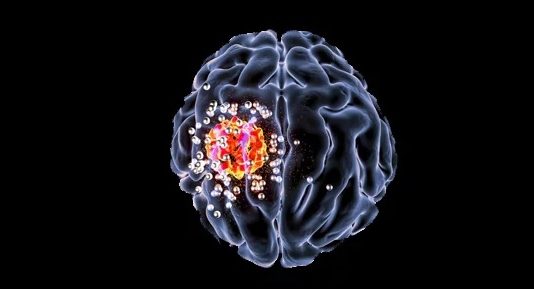 This new drug can halt spread of brain cancer