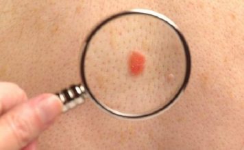 Novel protein linked to skin cancer identified