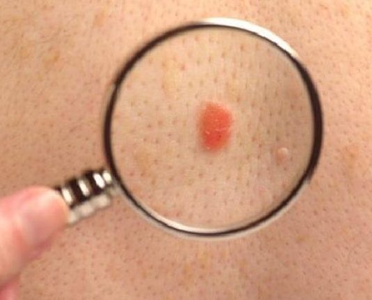 Novel protein linked to skin cancer identified